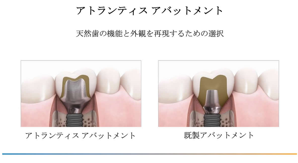 デジタルインプラント