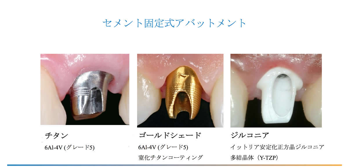 デジタルインプラント